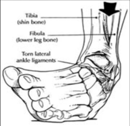 ankle-sprain